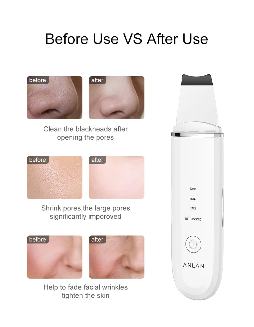 ANLAN Ultrasonic Skin Scrubber | EMS Lifting, Deep Cleansing, Ultrasonic Peeling