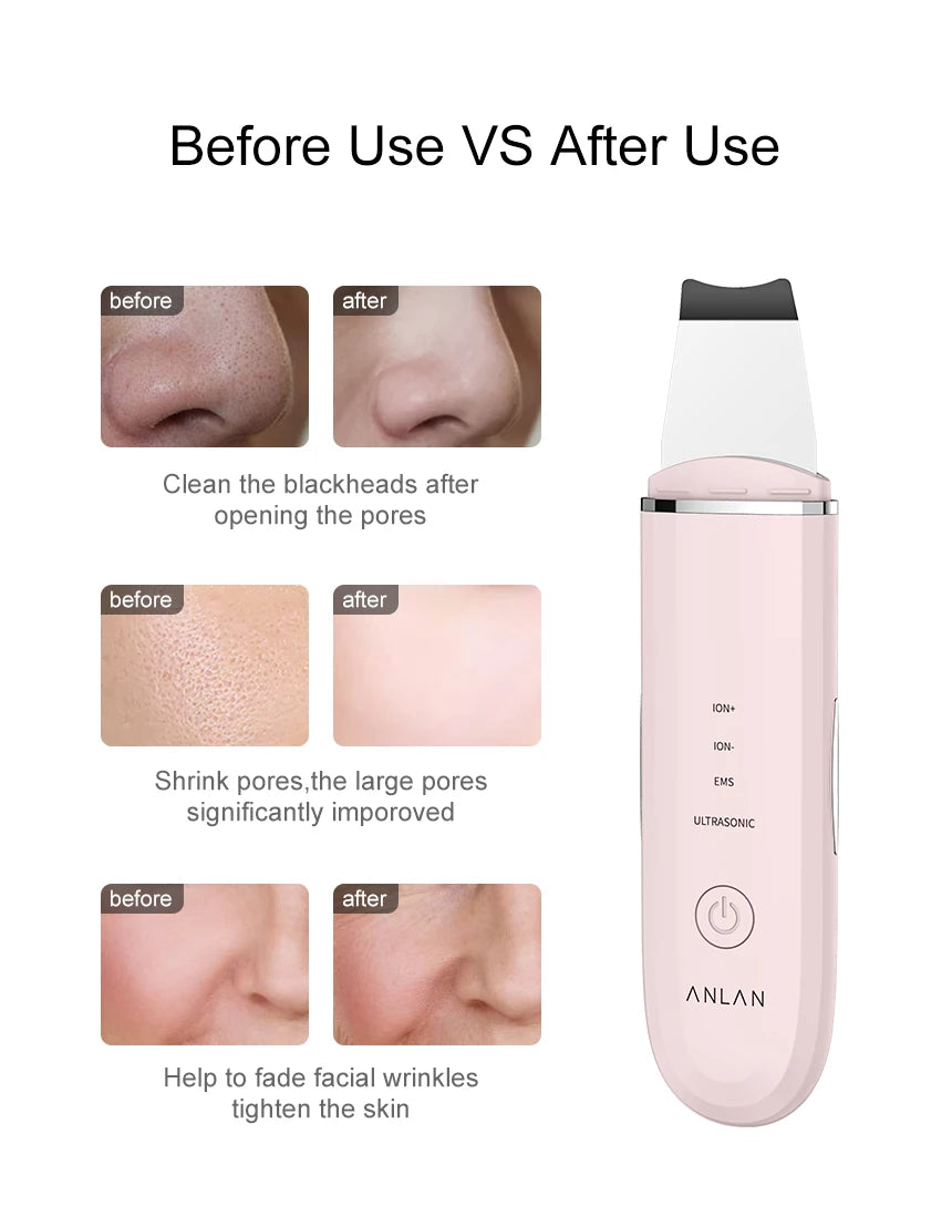 ANLAN Ultrasonic Skin Scrubber | Deep Cleaning, Peeling, EMS Lifting, Facial Shovel